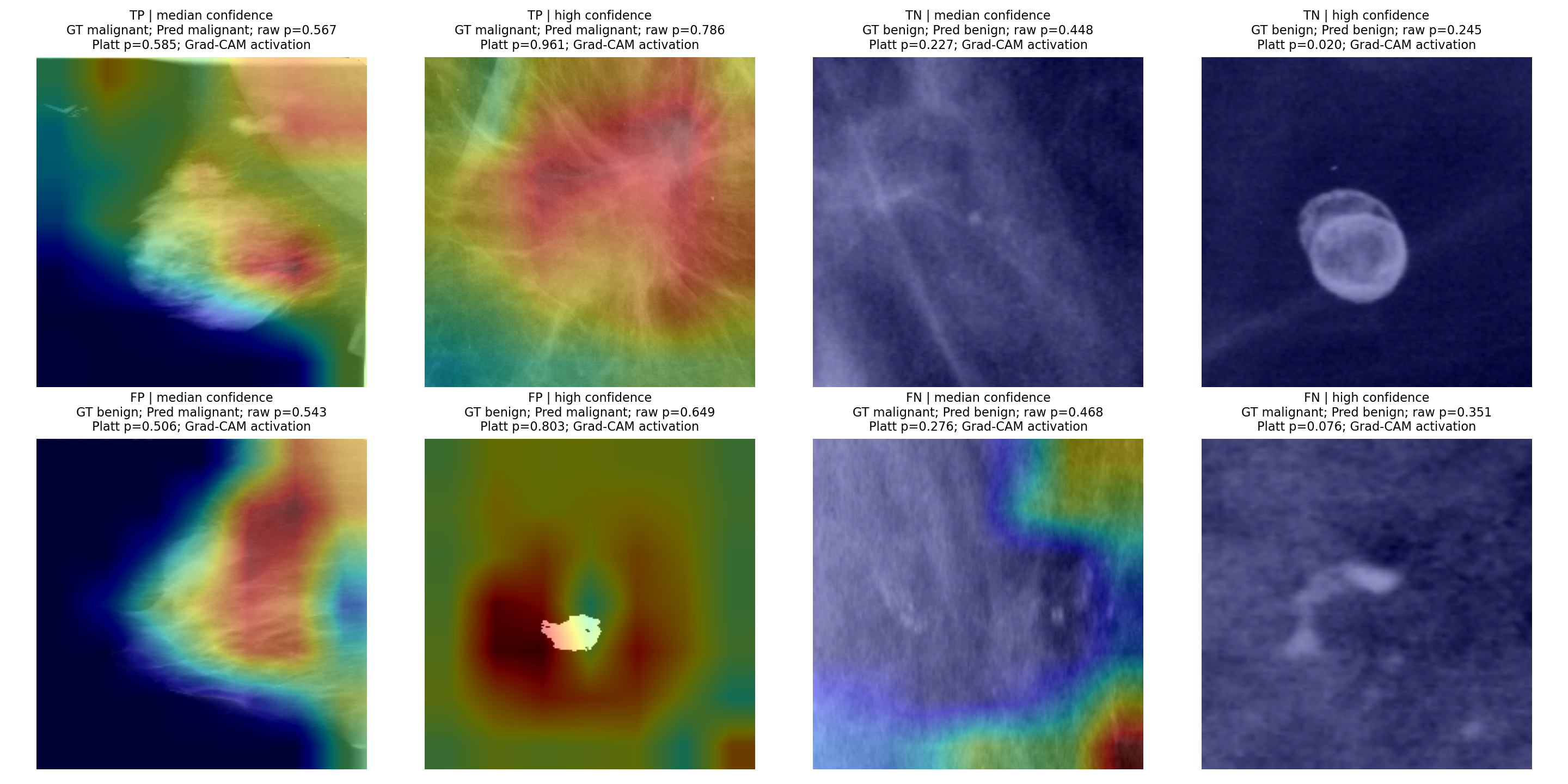 Grad-CAM heatmaps for EfficientNet-B0 mammography classification