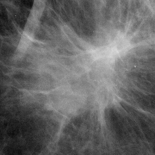 Clinical high-resolution mammogram demonstrating focal soft-tissue asymmetry